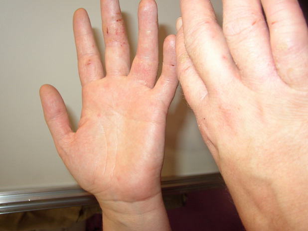 Hands with dry skin, red patches and splits