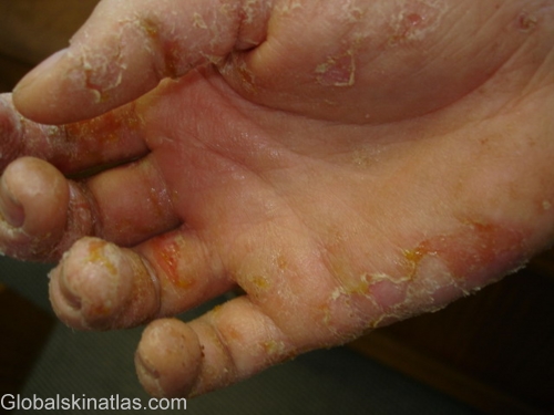 Hands with thickened, peeling and split skin