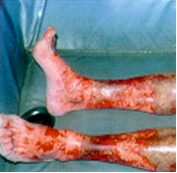 Legs with severe brown lesions from mid-calf to feet