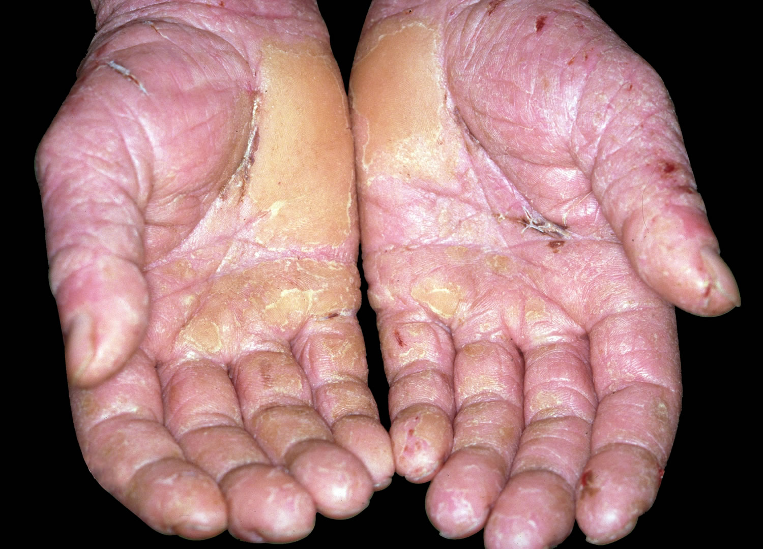 Hands showing crusting, thickening and splitting of skin