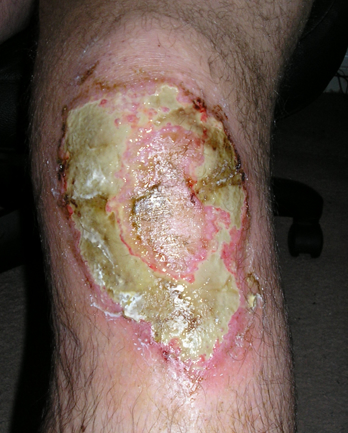 Knee with severe large white, pussy, infected lesion surrounded by redness