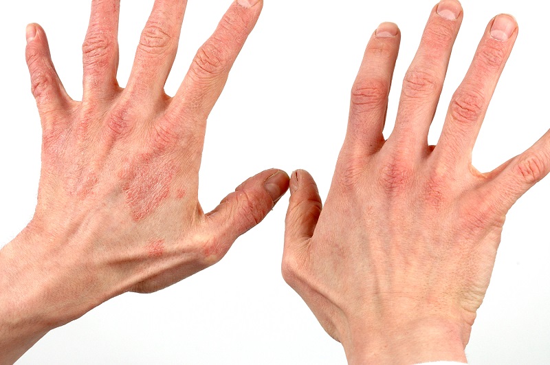 Hands with red scaly patches