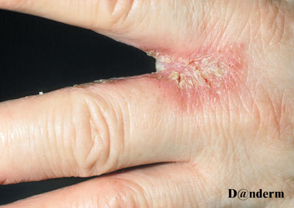 Red, split, infected lesion between fingers