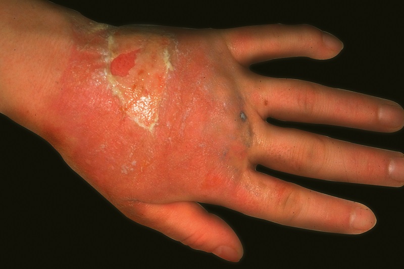 Extremely swollen red hands with areas of peeling skin