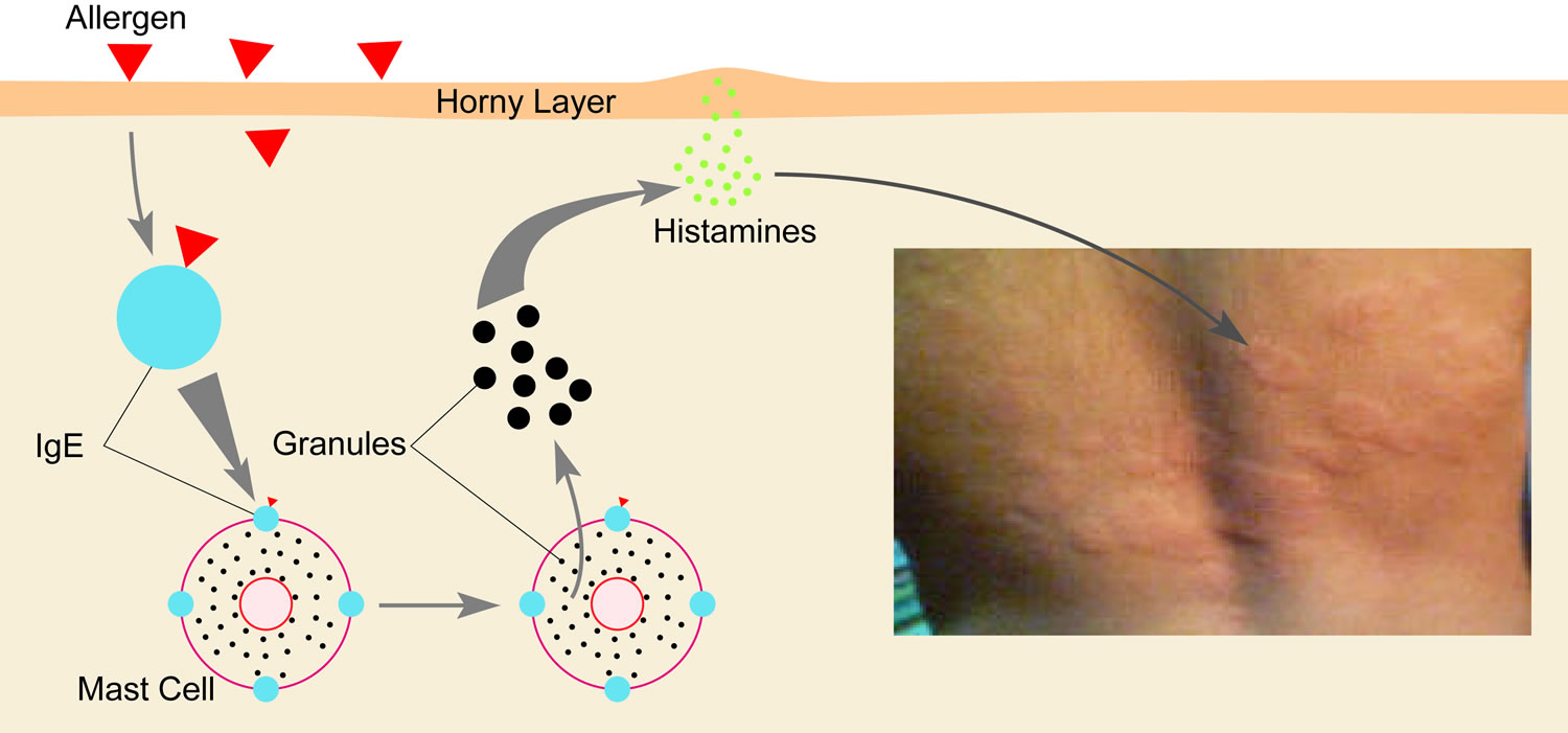 Skin reaction mechanism to allergen with insert photo of hives