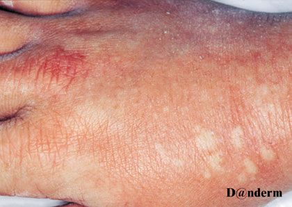 Hand with redness and white raised patches