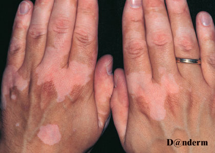 Dark skined hands with light patches