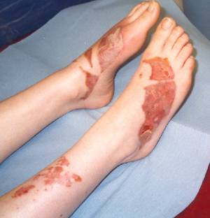 burned feet caused by the hot oil